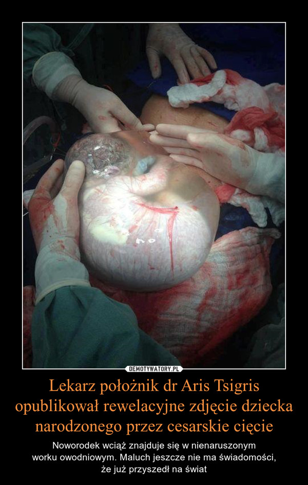 Lekarz położnik dr Aris Tsigris opublikował rewelacyjne zdjęcie dziecka narodzonego przez cesarskie cięcie – Noworodek wciąż znajduje się w nienaruszonymworku owodniowym. Maluch jeszcze nie ma świadomości,że już przyszedł na świat 