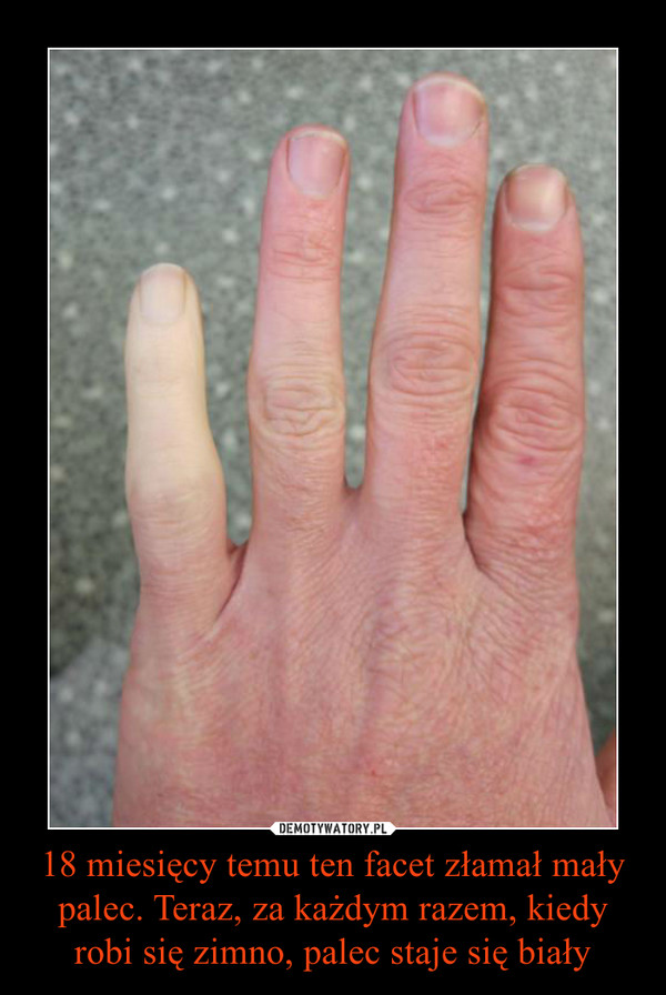 18 miesięcy temu ten facet złamał mały palec. Teraz, za każdym razem, kiedy robi się zimno, palec staje się biały –  