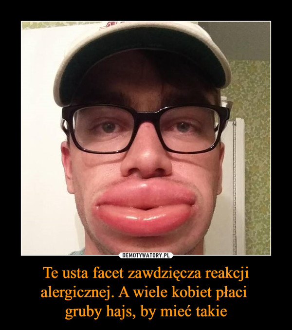 Te usta facet zawdzięcza reakcji alergicznej. A wiele kobiet płaci gruby hajs, by mieć takie –  