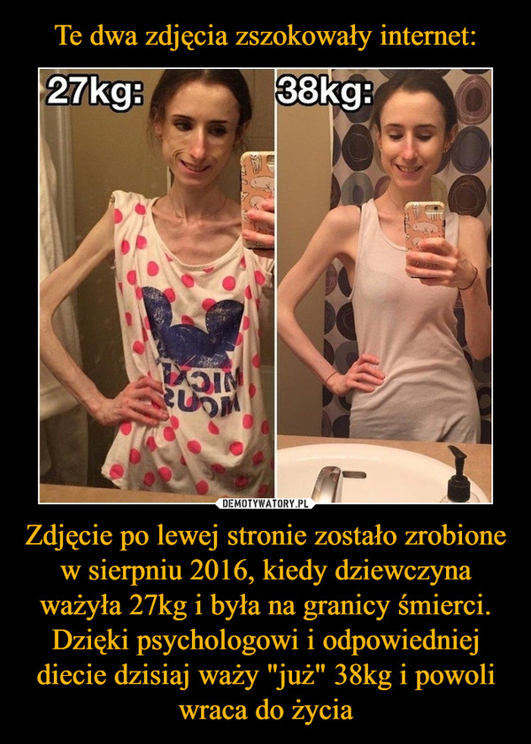 Te dwa zdjęcia zszokowały internet: Zdjęcie po lewej stronie zostało zrobione w sierpniu 2016, kiedy dziewczyna ważyła 27kg i była na granicy śmierci. Dzięki psychologowi i odpowiedniej diecie dzisiaj waży "już" 38kg i powoli wraca do życia