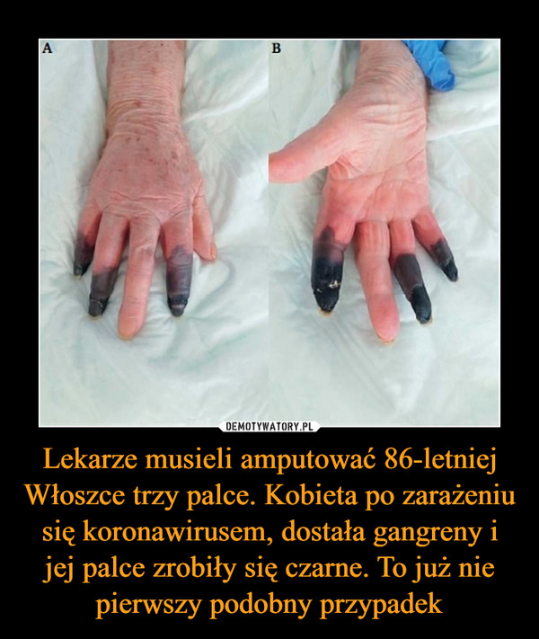 Lekarze musieli amputować 86-letniej Włoszce trzy palce. Kobieta po zarażeniu się koronawirusem, dostała gangreny i jej palce zrobiły się czarne. To już nie pierwszy podobny przypadek